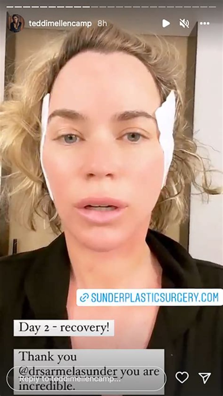 Teddi Mellencamp Opens Up About Plastic Surgery