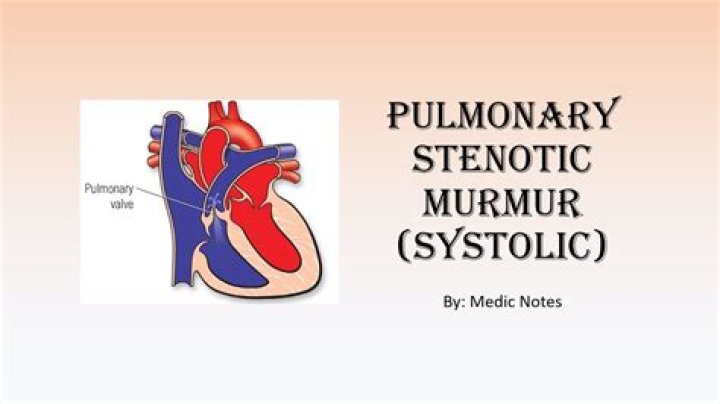 What is a PPS murmur?