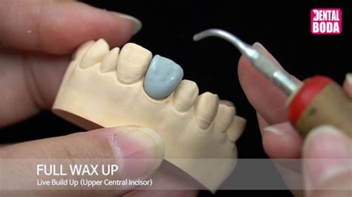 What is a wax up in dentistry?