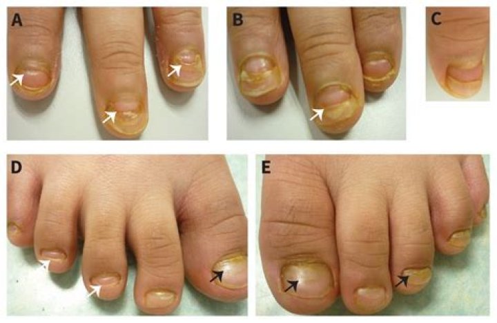 Why do toenails fall off after hand foot and mouth?